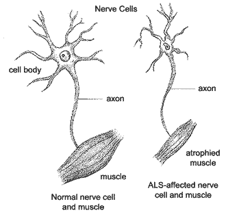 ALS Amyotrophic lateral sclerosis